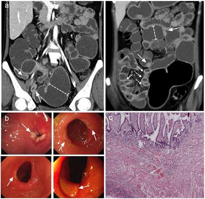 What is the appropriate treatment strategy for cryptogenic multifocal ulcerative stenosing enteritis? A single-center experience from China